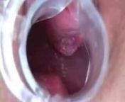 Wife has Speculum Orgasm Contractions 0:46 from new pictur 0 0 text