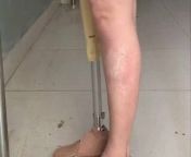 Prosthesis amputee – shd from shd sexy